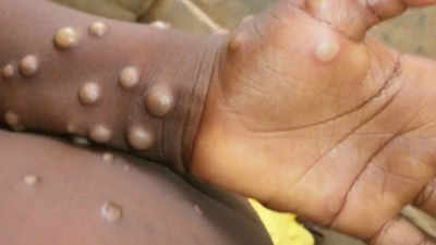 Ghana confirms 18 additional Mpox cases, bringing total to 346