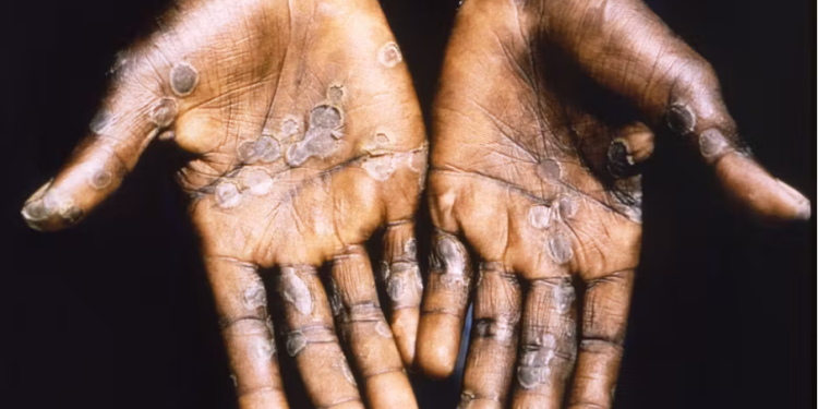 Nkwanta North District contains first case of Mpox