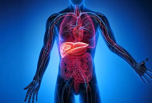 Hepatitis B remains leading cause of liver cancer in Ghana – Dr. Asare Offei