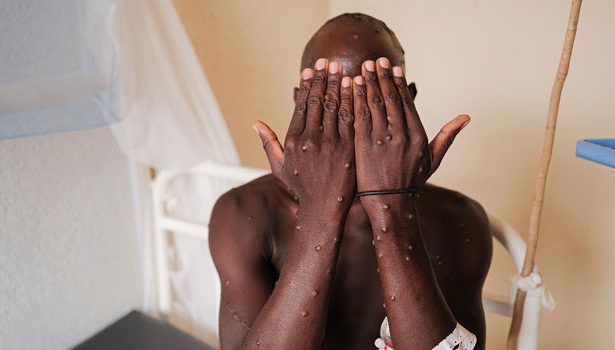Mpox cases climb to 980 as GHS confirms 12 new infections